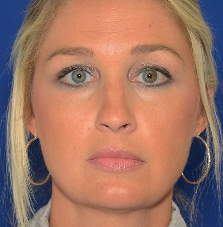 Rhinoplasty Before & After Photo #1