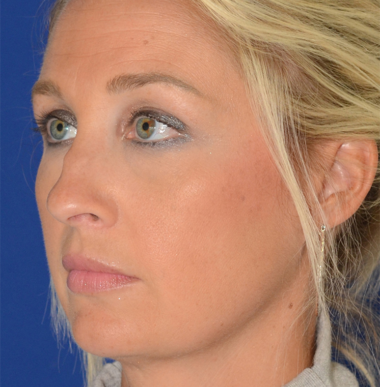 Rhinoplasty Before & After Photo #3