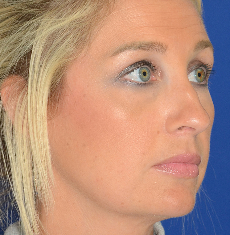 Rhinoplasty Before & After Photo #5