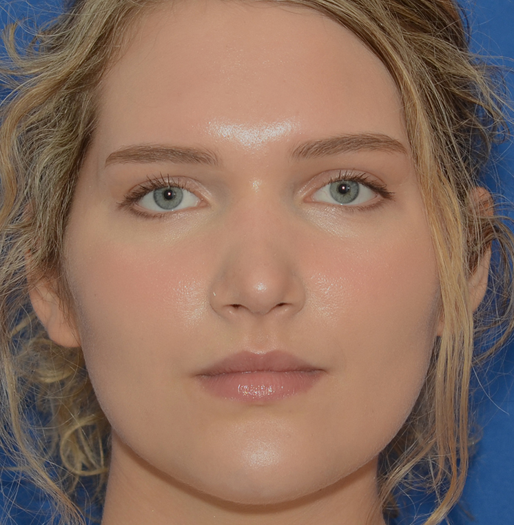Rhinoplasty Before & After Photo #2
