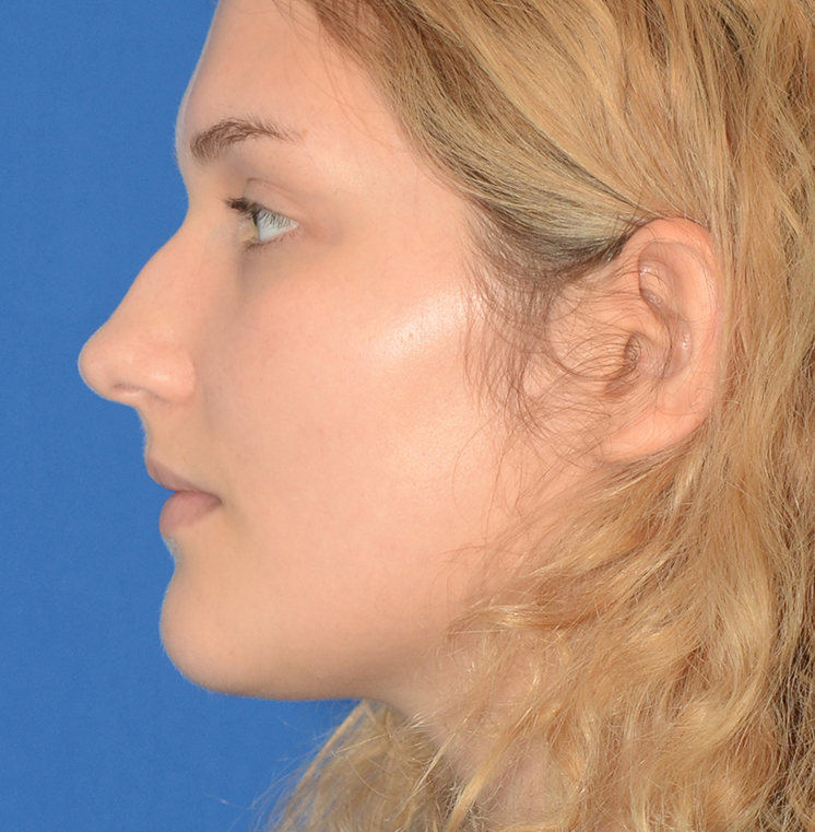Rhinoplasty Before & After Photo #7