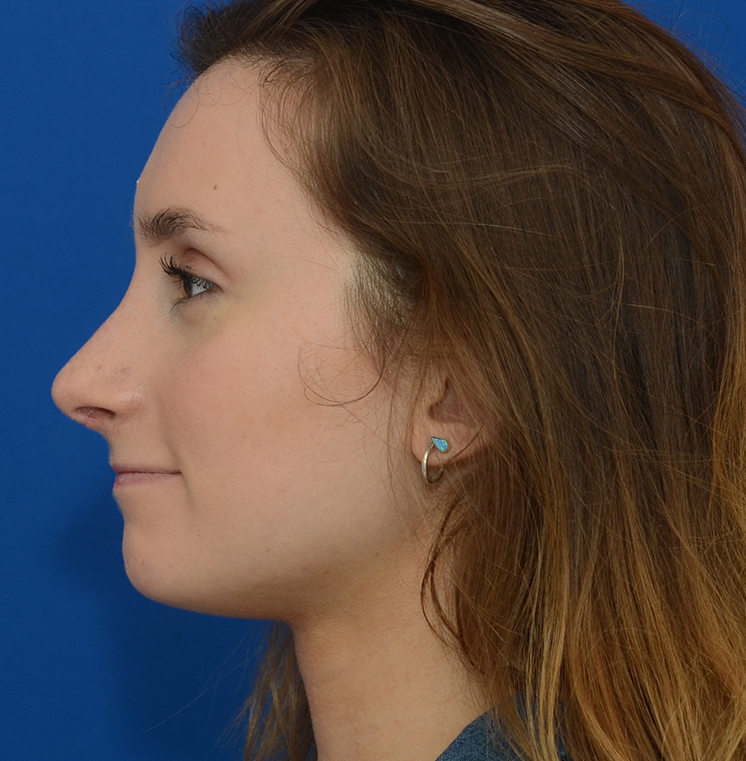 Rhinoplasty Before & After Photo #8