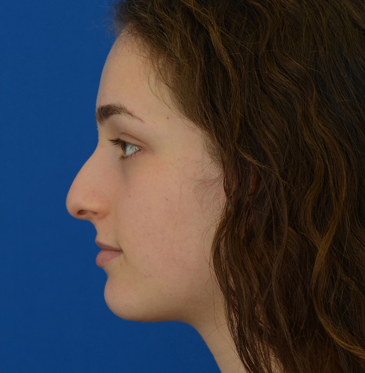 Rhinoplasty Before & After Photo #7