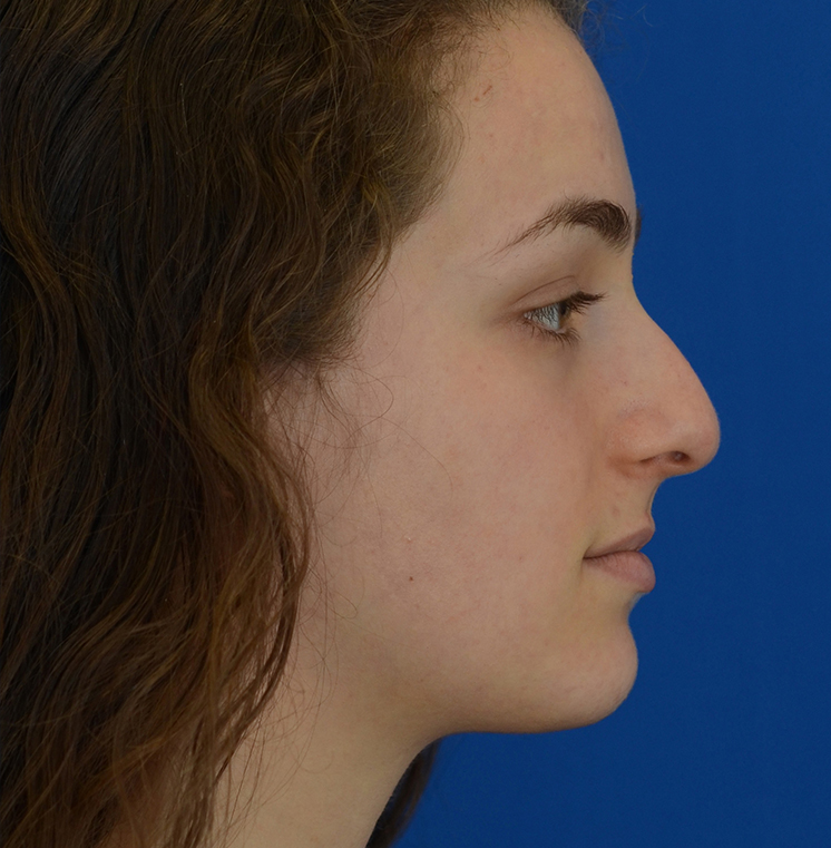 Rhinoplasty Before & After Photo #11