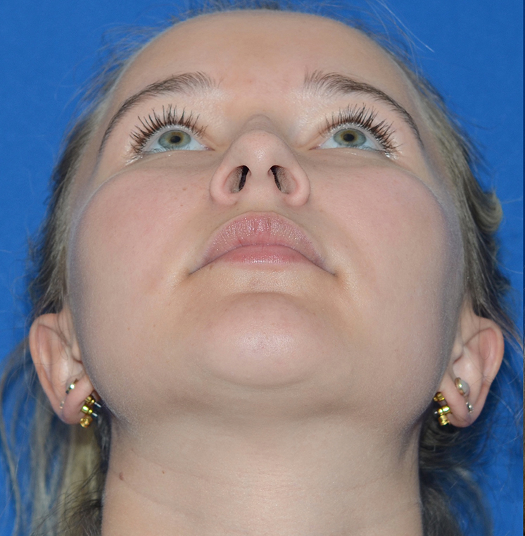 Rhinoplasty Before & After Photo #3