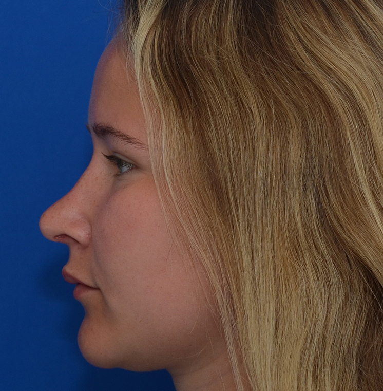 Rhinoplasty Before & After Photo #8