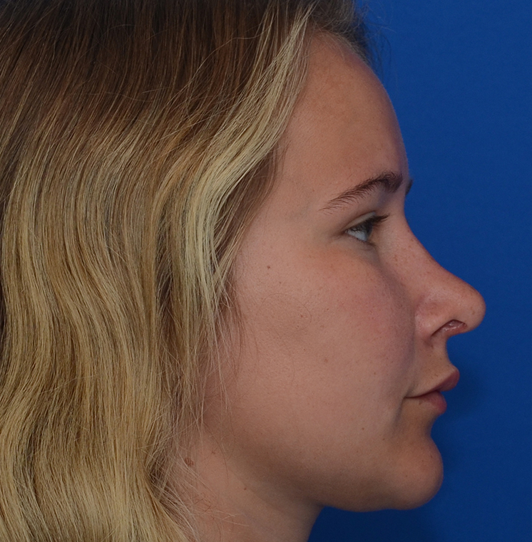 Rhinoplasty Before & After Photo #12