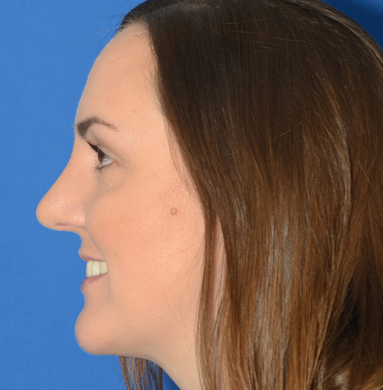 Rhinoplasty Before & After Photo #4