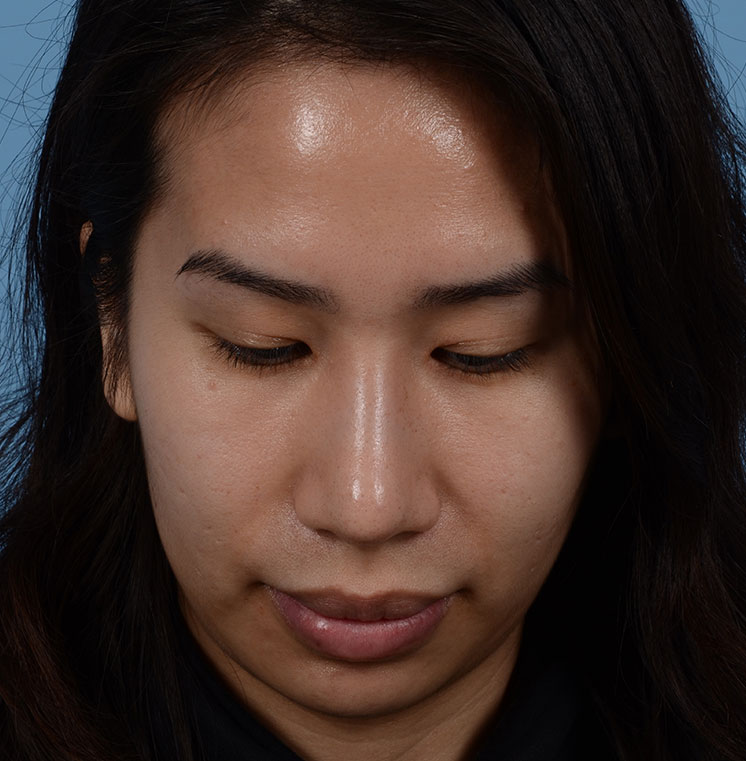 Rhinoplasty Before & After Photo #6