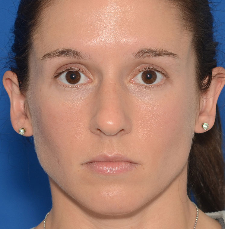 Rhinoplasty Before & After Photo #1
