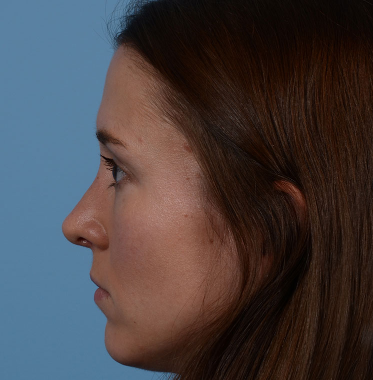 Rhinoplasty Before & After Photo #10