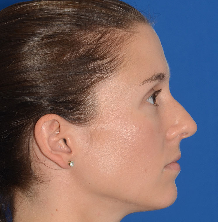 Rhinoplasty Before & After Photo #13