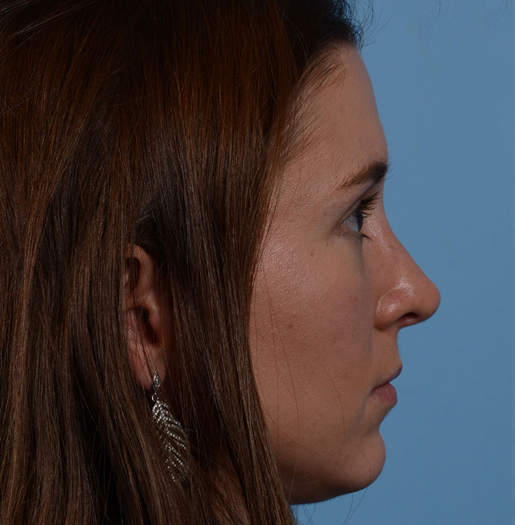 Rhinoplasty Before & After Photo #14