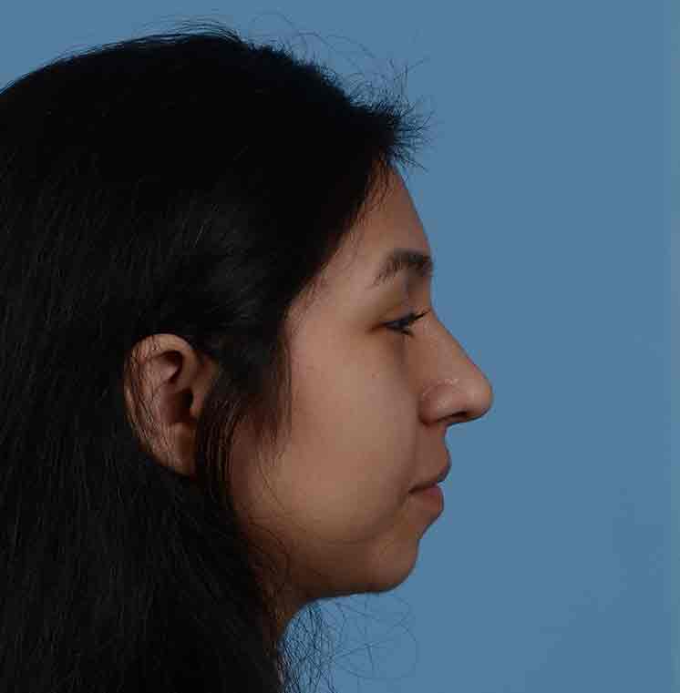 Rhinoplasty Before & After Photo #14