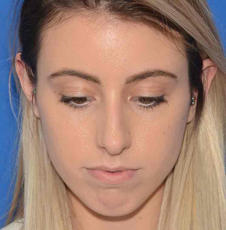 Rhinoplasty Before & After Photo #5