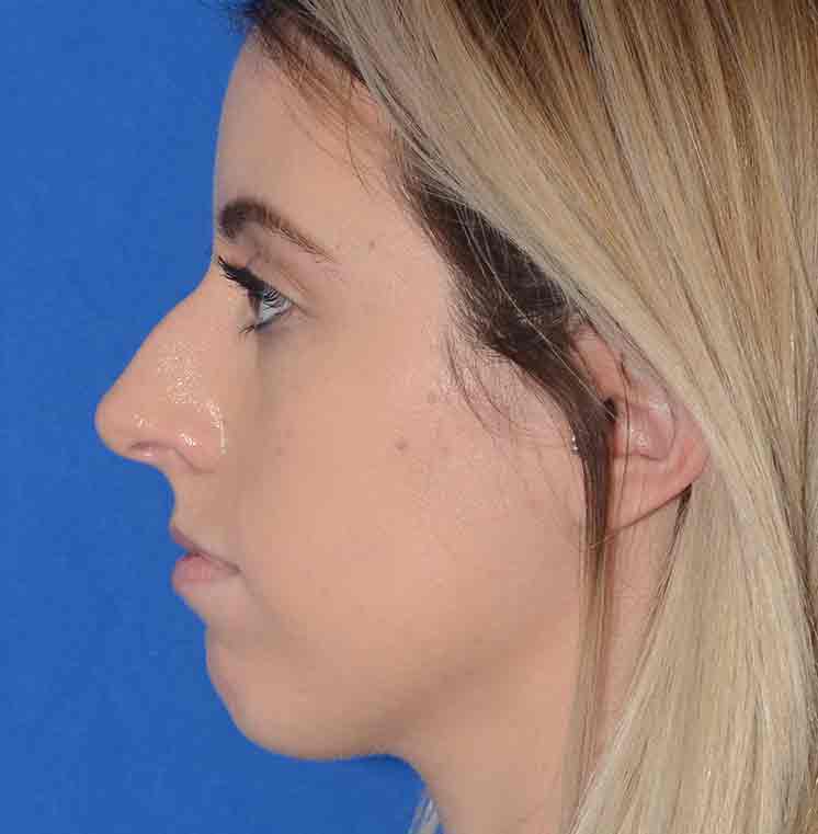 Rhinoplasty Before & After Photo #9