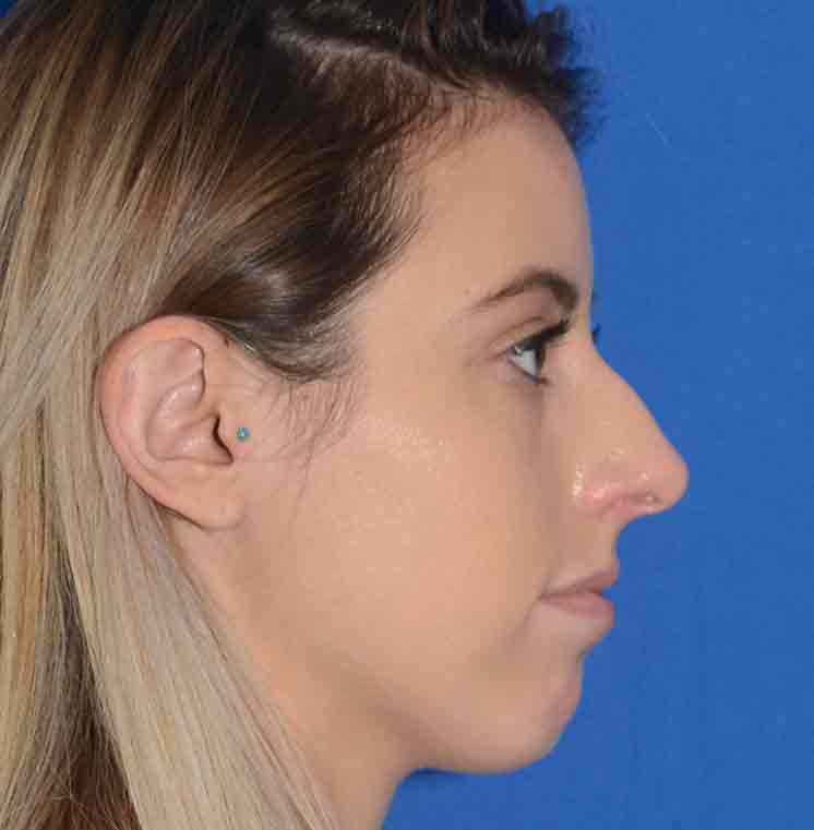 Rhinoplasty Before & After Photo #13