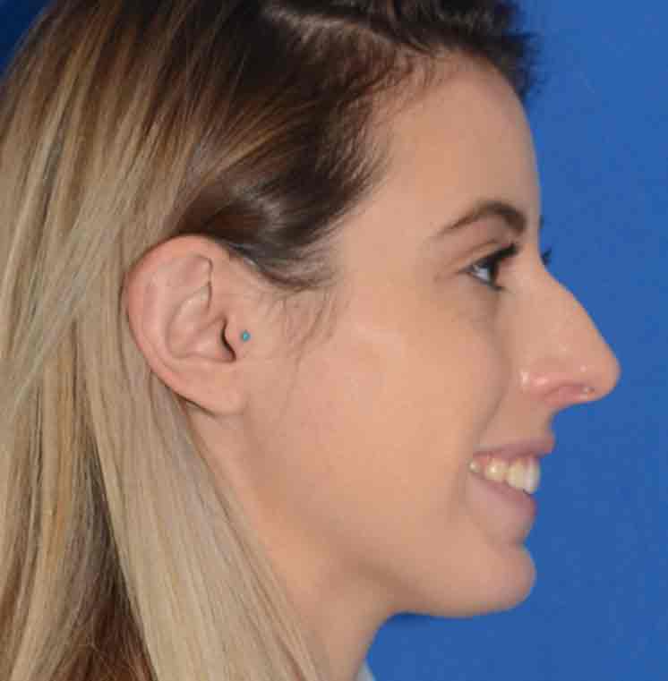 Rhinoplasty Before & After Photo #15