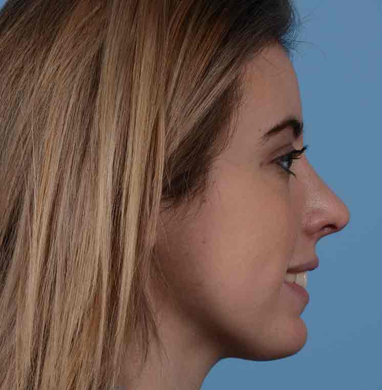 Rhinoplasty Before & After Photo #16