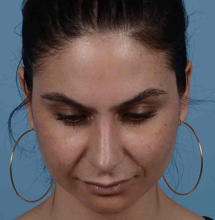 Rhinoplasty Before & After Photo #6
