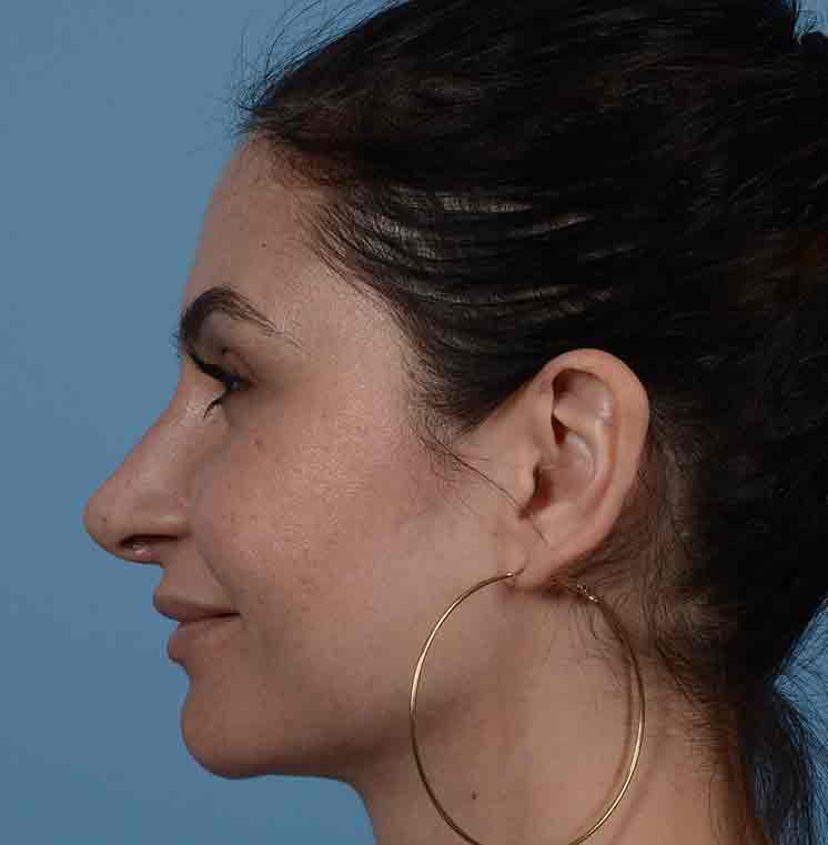 Rhinoplasty Before & After Photo #10