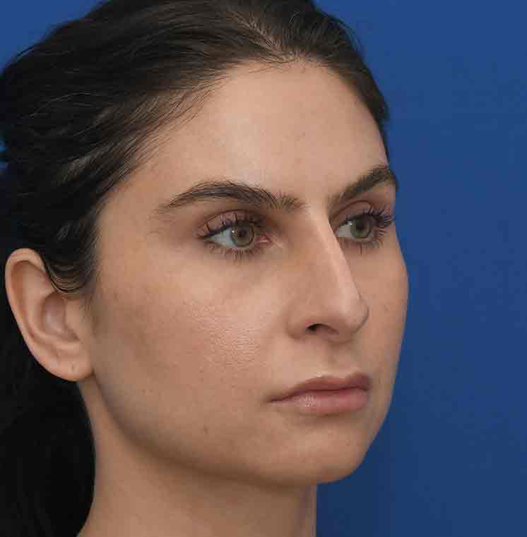 Rhinoplasty Before & After Photo #11