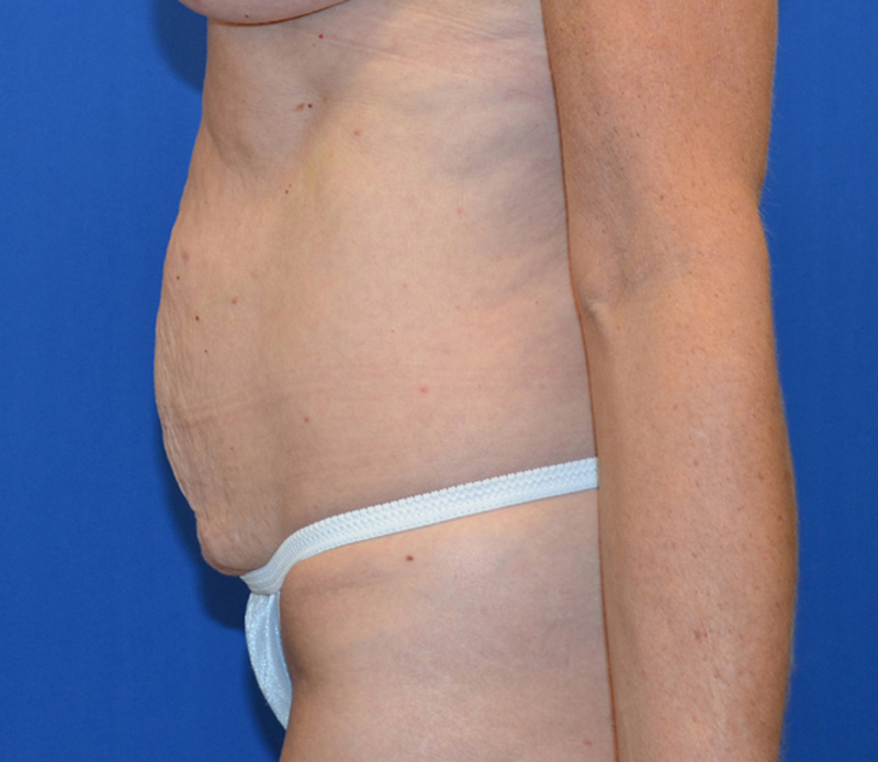 Tummy Tuck Before & After Photo #3