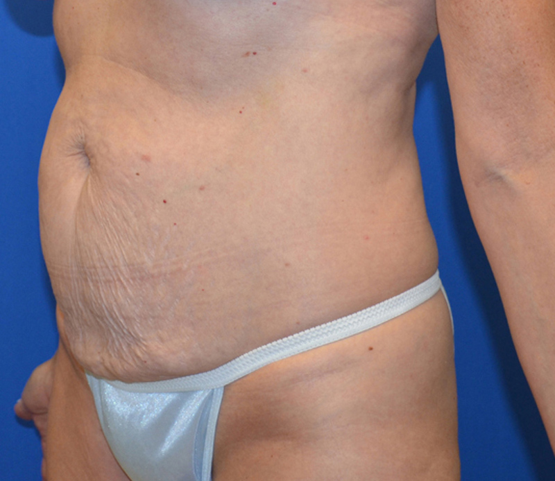 Tummy Tuck Before & After Photo #5