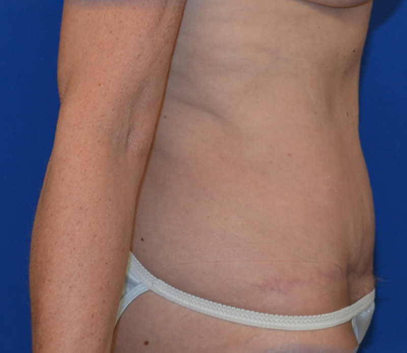 Tummy Tuck Before & After Photo #8