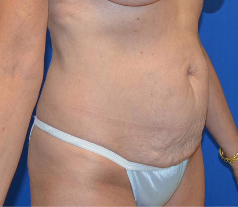 Tummy Tuck Before & After Photo #9