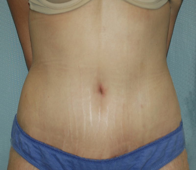 Tummy Tuck Before & After Photo #2