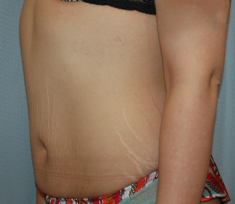 Tummy Tuck Before & After Photo #3