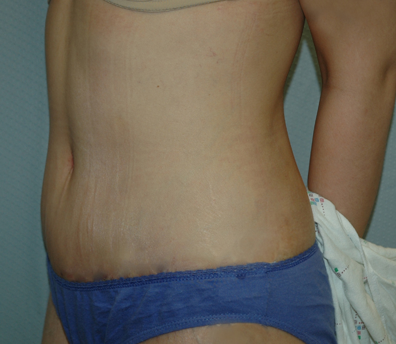 Tummy Tuck Before & After Photo #4
