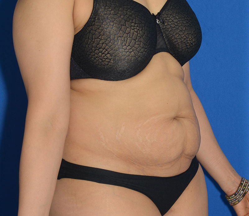 Tummy Tuck Before & After Photo #7